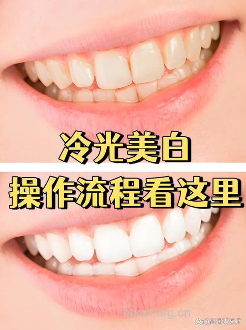进行冷光美白牙齿步骤