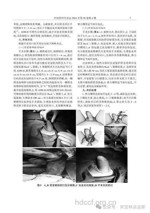 进行阴茎整形手术有哪些介绍