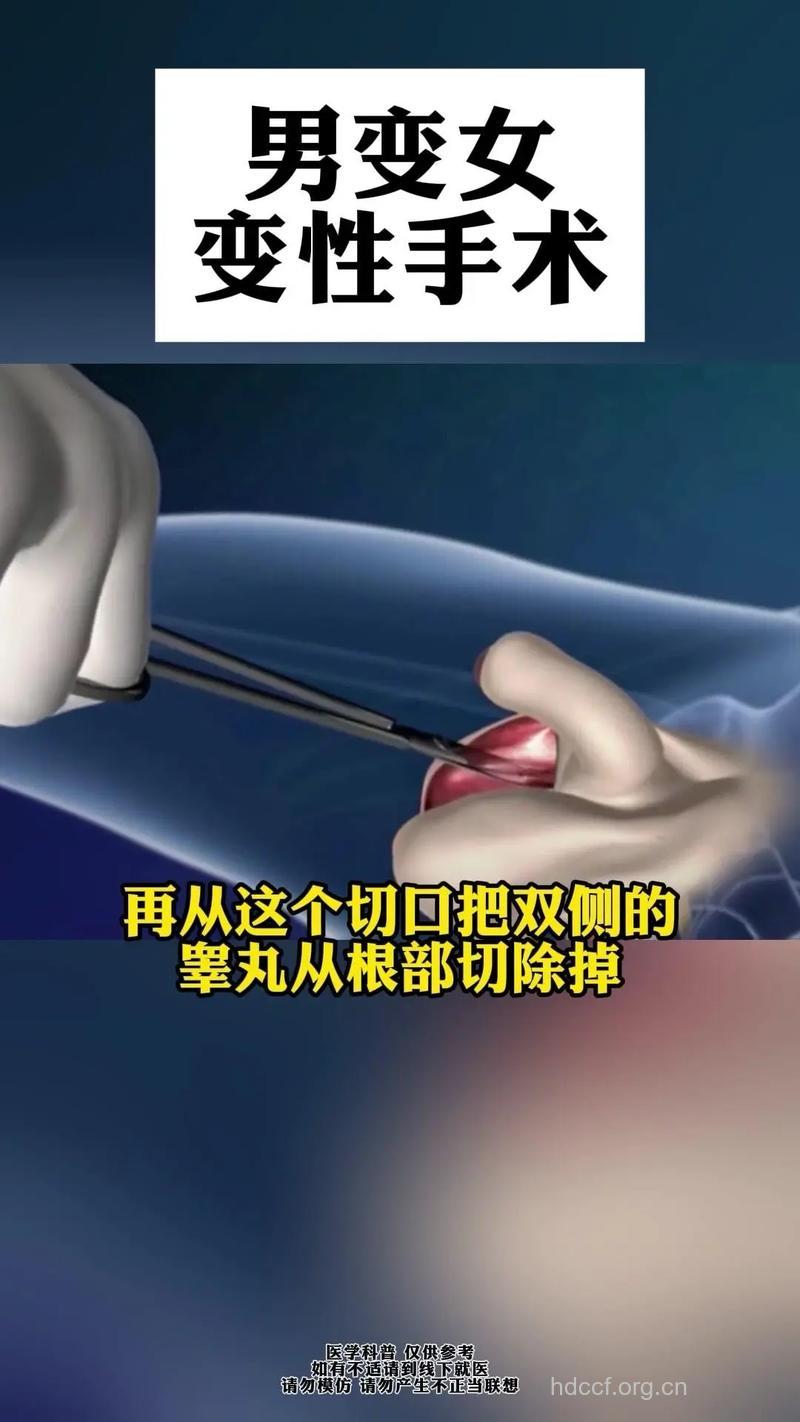 怎么进行变性手术方法