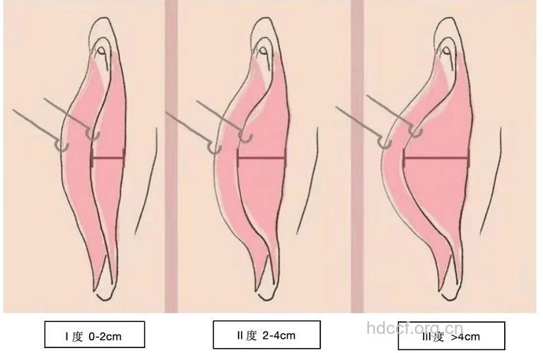 怎么进行外阴整形手术方法