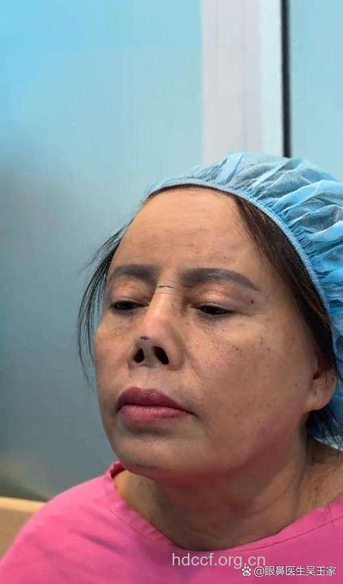 假体隆鼻过高的两大后果