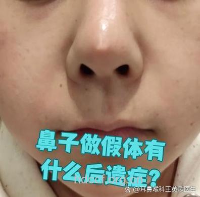 硅胶隆鼻会有哪些后遗症？