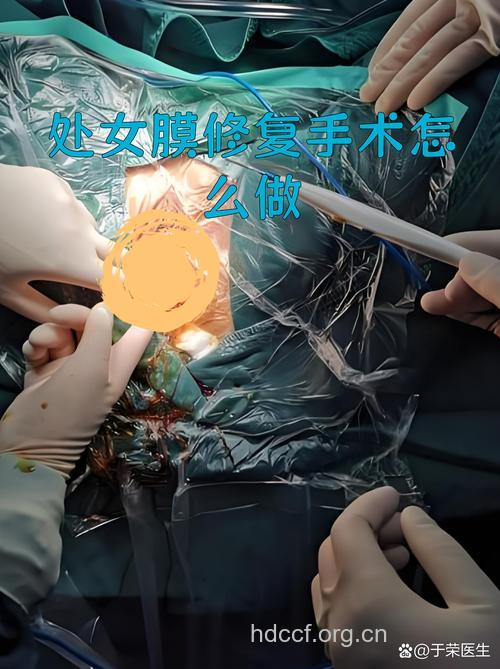 处女膜修补术之缝合法