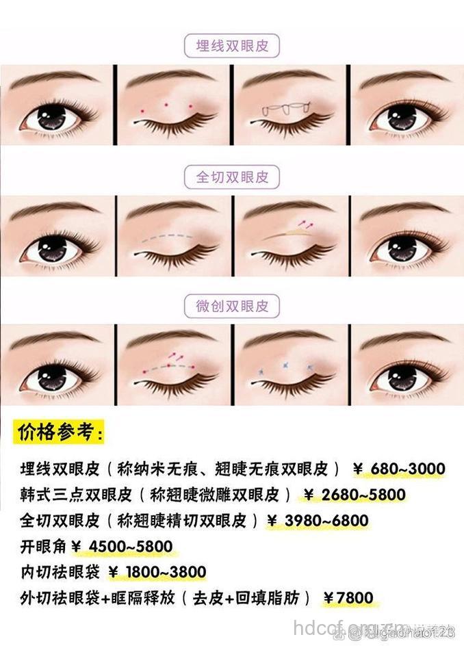 割双眼皮需要多少钱呢?