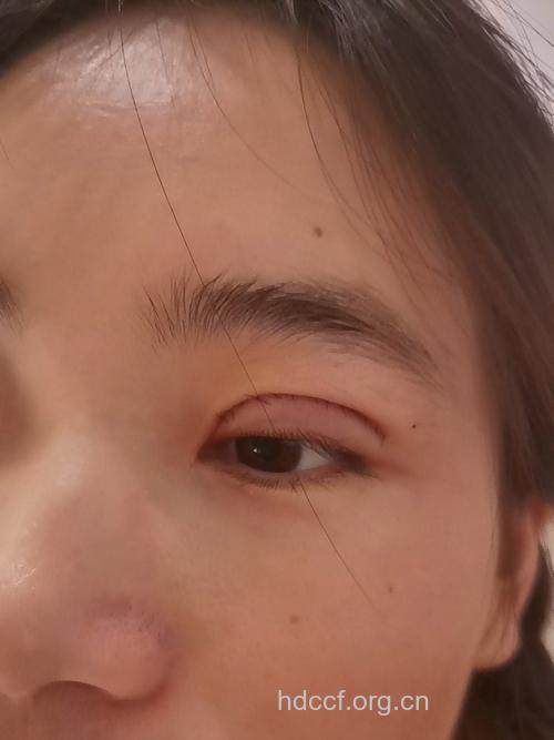 割双眼皮我还有多少不知道？