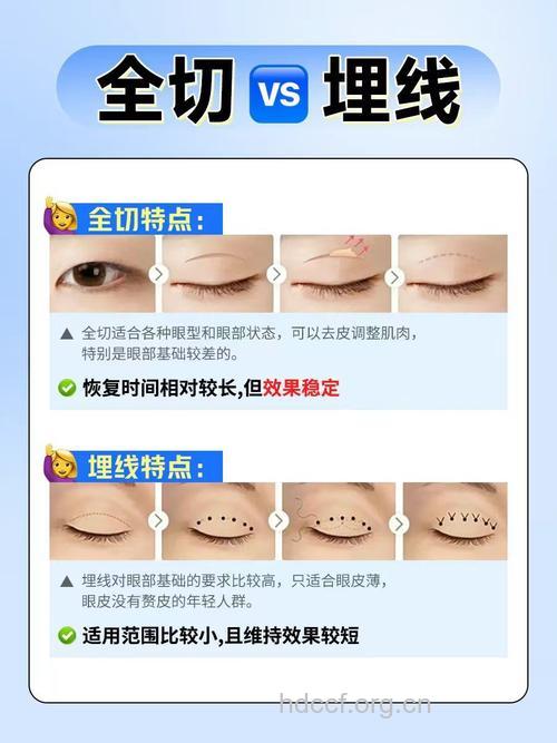 做双眼皮是切开好还是埋线好