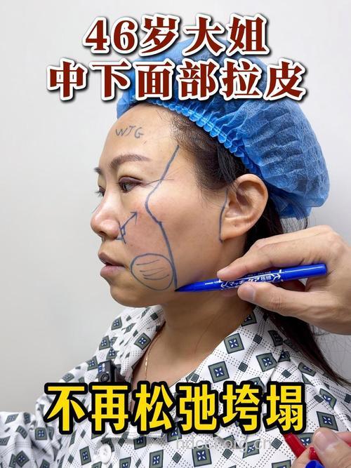 熟知拉皮除皱的操作过程