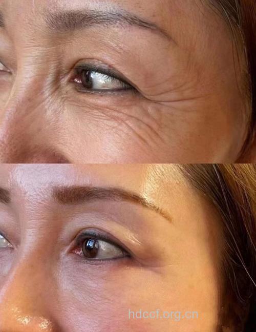 揭开最好的除皱方法的真面目