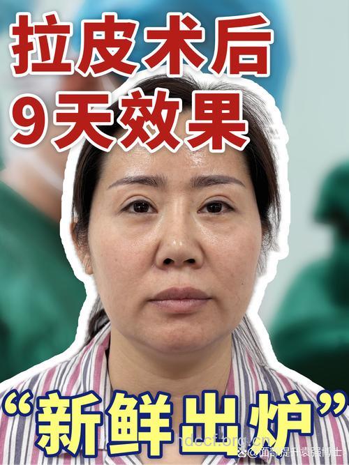 整容手术对治疗面部松弛有特效