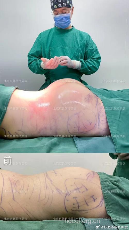 吸脂提臀术 帮你的臀部翘起来