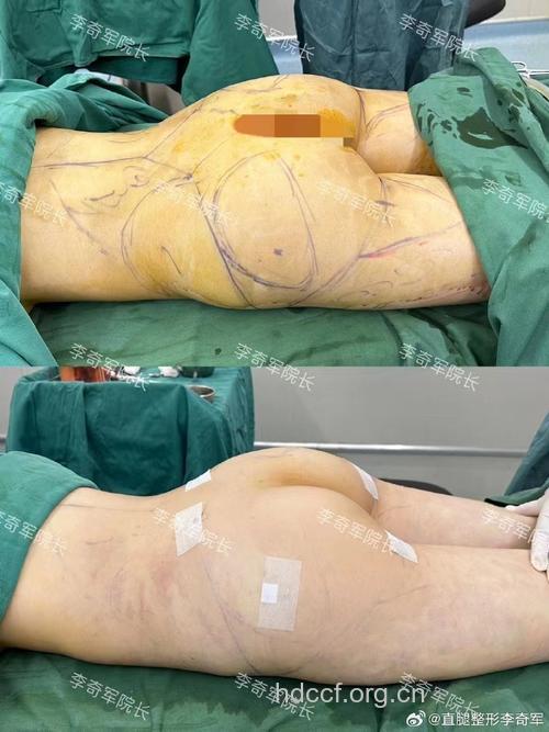 丰臀手术 女性新时尚整形