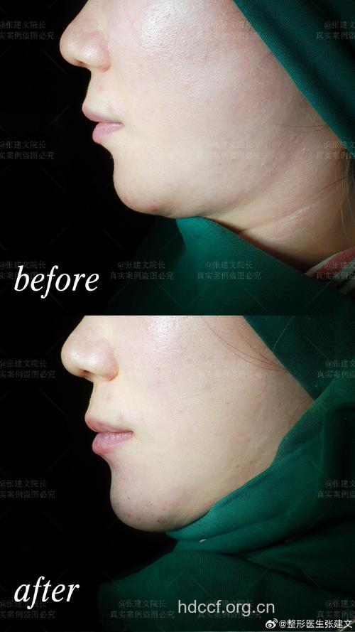 注射隆下巴手术的优势