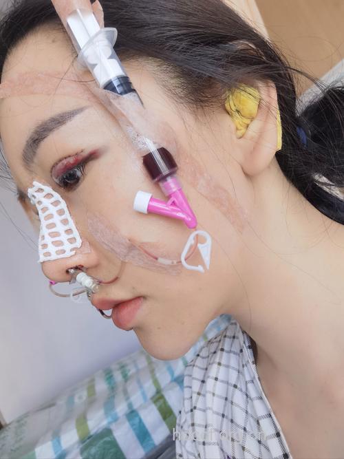 常见隆鼻手术有哪些