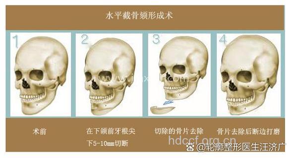 隆下巴手术有什么手术原理