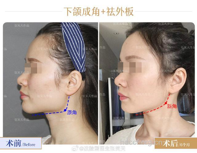 怎么进行短下巴整形手术方法