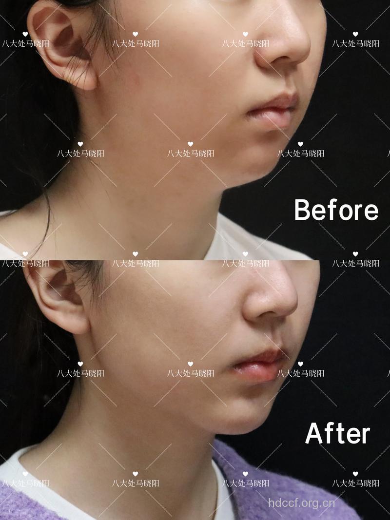 哪些因素影响假体隆下巴的手术效果