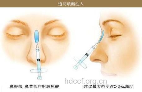 注射玻尿酸隆鼻的手术方式