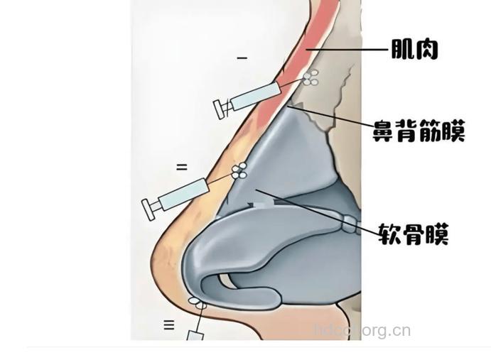 注射隆鼻有什么手术过程