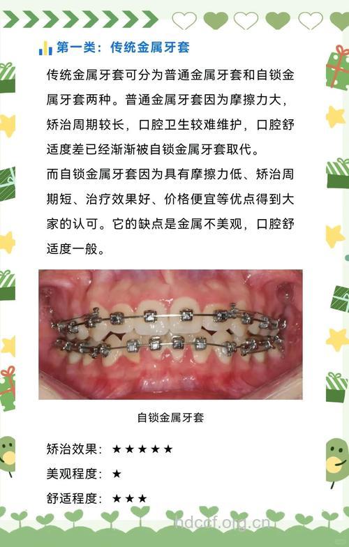 MBT弓丝正畸牙齿有哪些优点