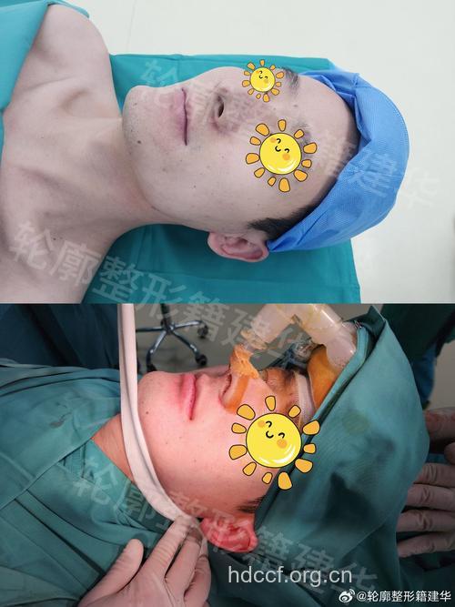 下颌角肥大整形手术是怎样进行的