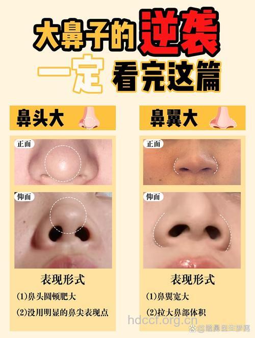 关于隆鼻的几个问题