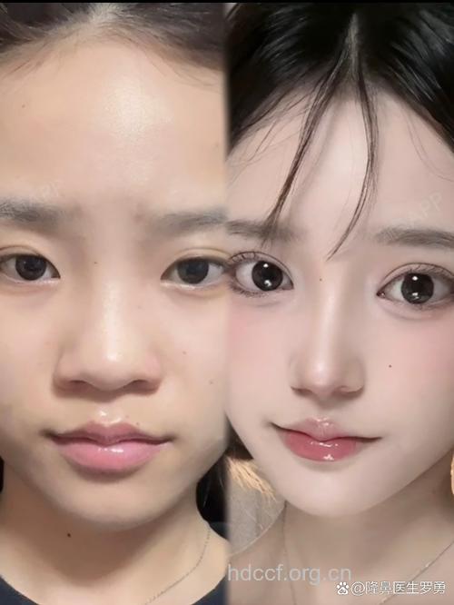 小鼻尖整形大学问