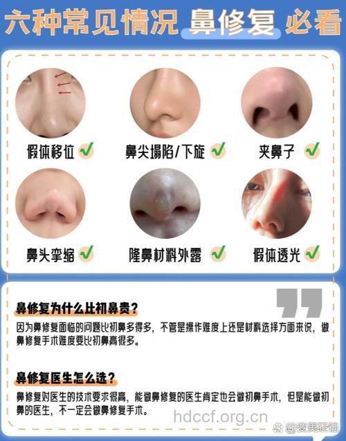 隆鼻失败后修复的常识