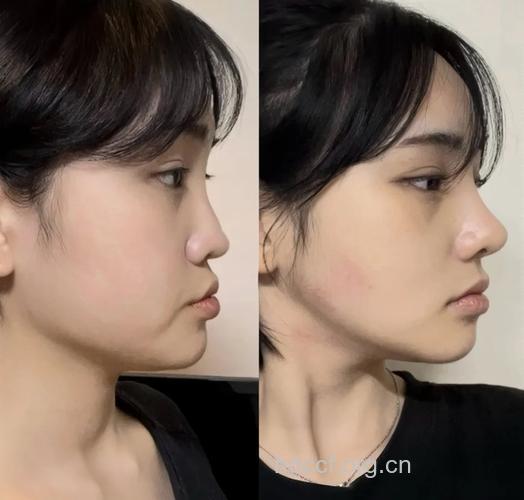 隆出什么样的鼻子才算成功呢？