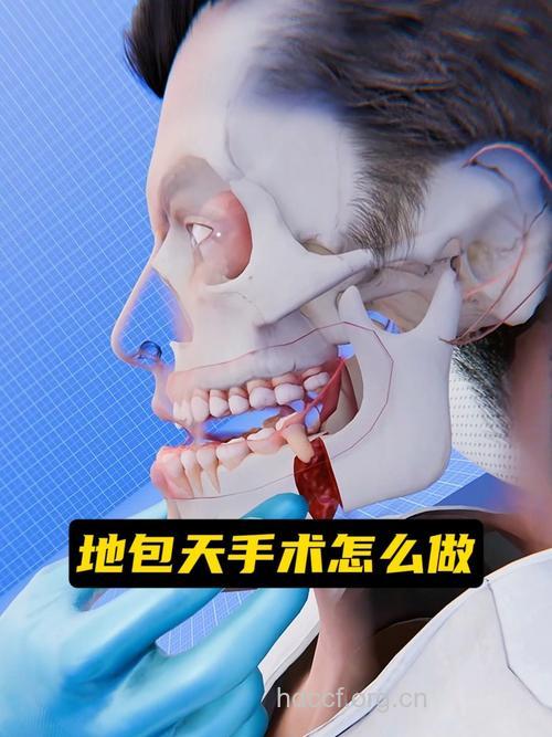 反颌畸形的手术方法