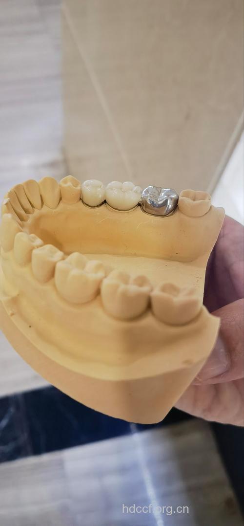 适合做烤瓷牙修复的有哪几类