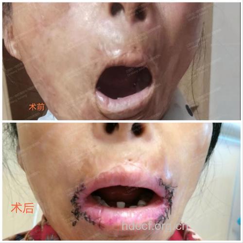 小口畸形的治疗方法有哪些