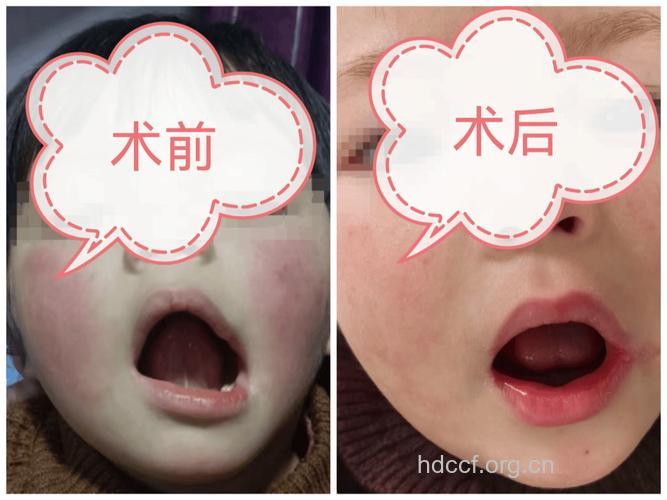 大口畸形产生原因及治疗方法