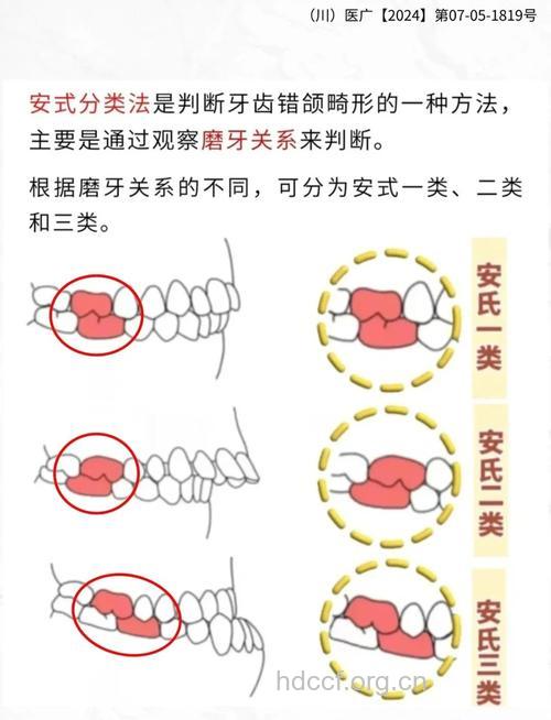 牙齿咬合不正的分类及治疗方法
