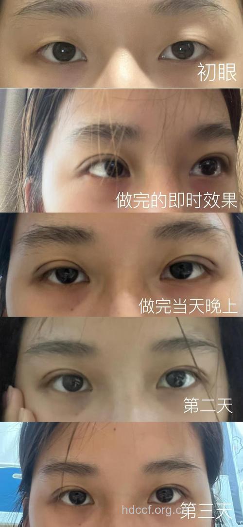 埋式双眼皮手术有哪些特点