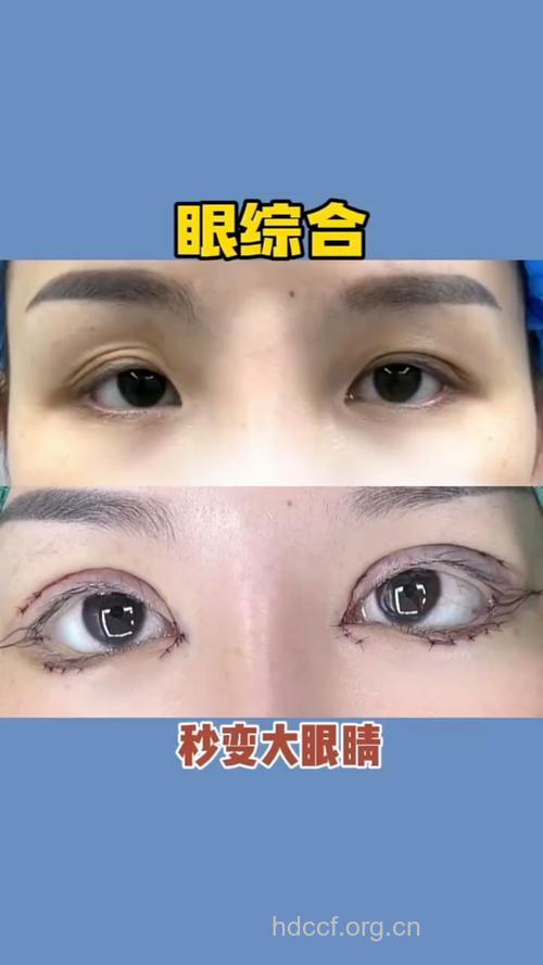 让眼睛变大的整形手术有哪些