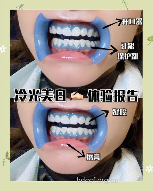 冷光牙齿美白技术美白的过程