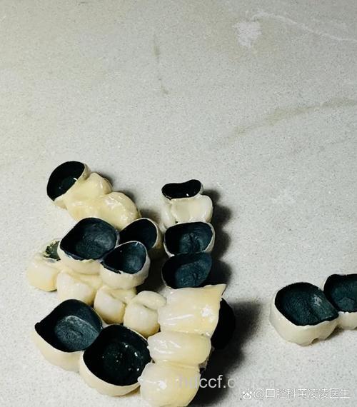 什么是烤瓷牙内冠