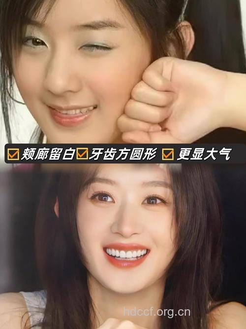 明星也用的美容冠牙齿整形