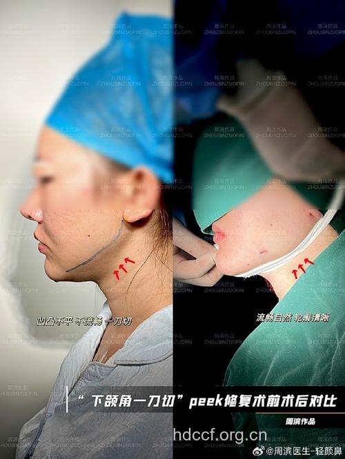 下颌角整形手术有哪些特点