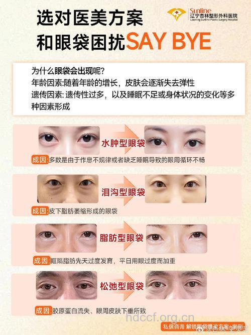 吸脂祛眼袋的四大优点