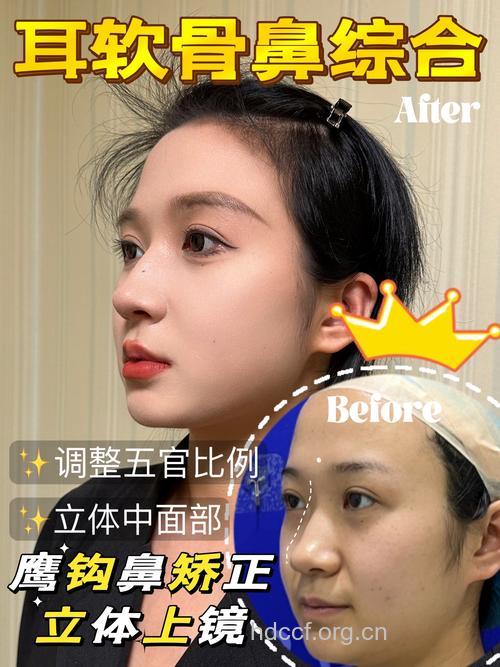 “鹰钩鼻”整形的方法