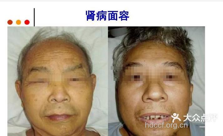 案例分析 揭开尿毒症的面纱