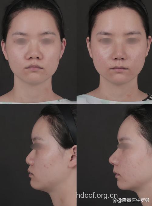 自体软骨隆鼻的术前术后