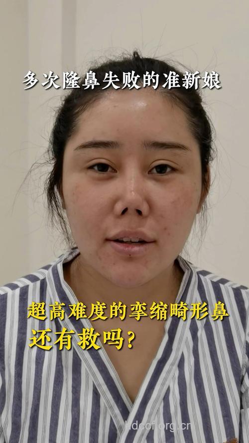 隆鼻术失败有哪些表现