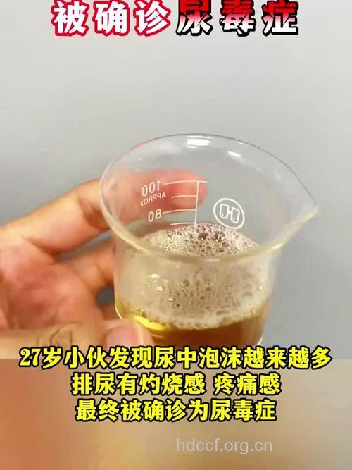 憋尿憋出尿毒症