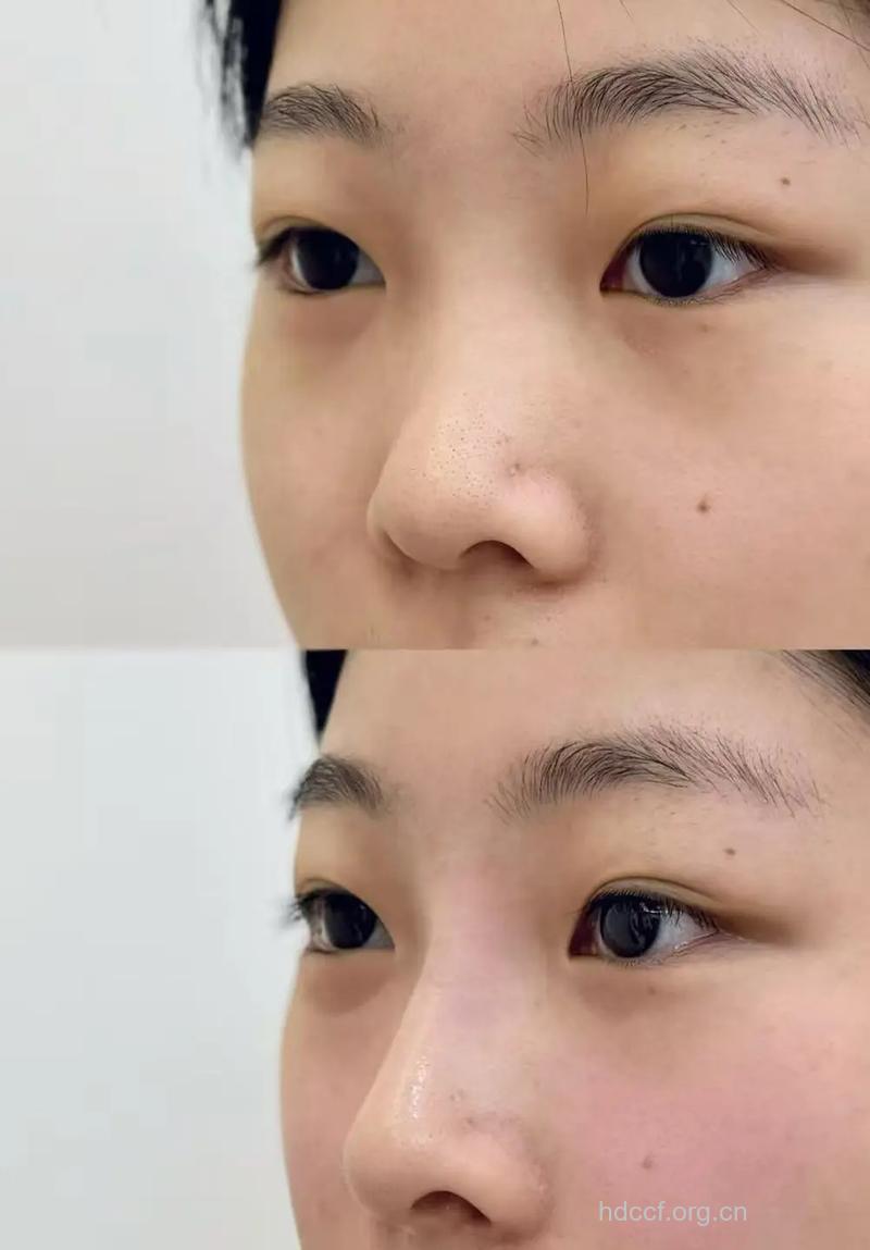 手术隆鼻和玻尿酸隆鼻哪种好