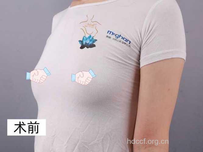 麦格假体隆胸术有哪些特点