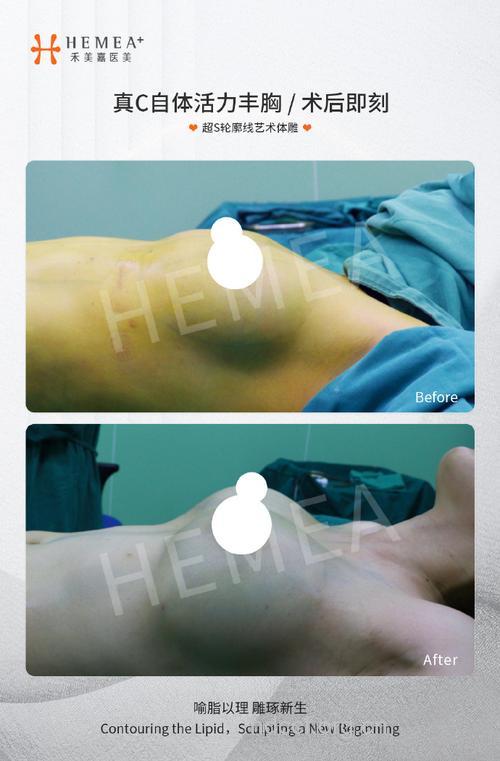 自体脂肪隆胸朮有哪些特点