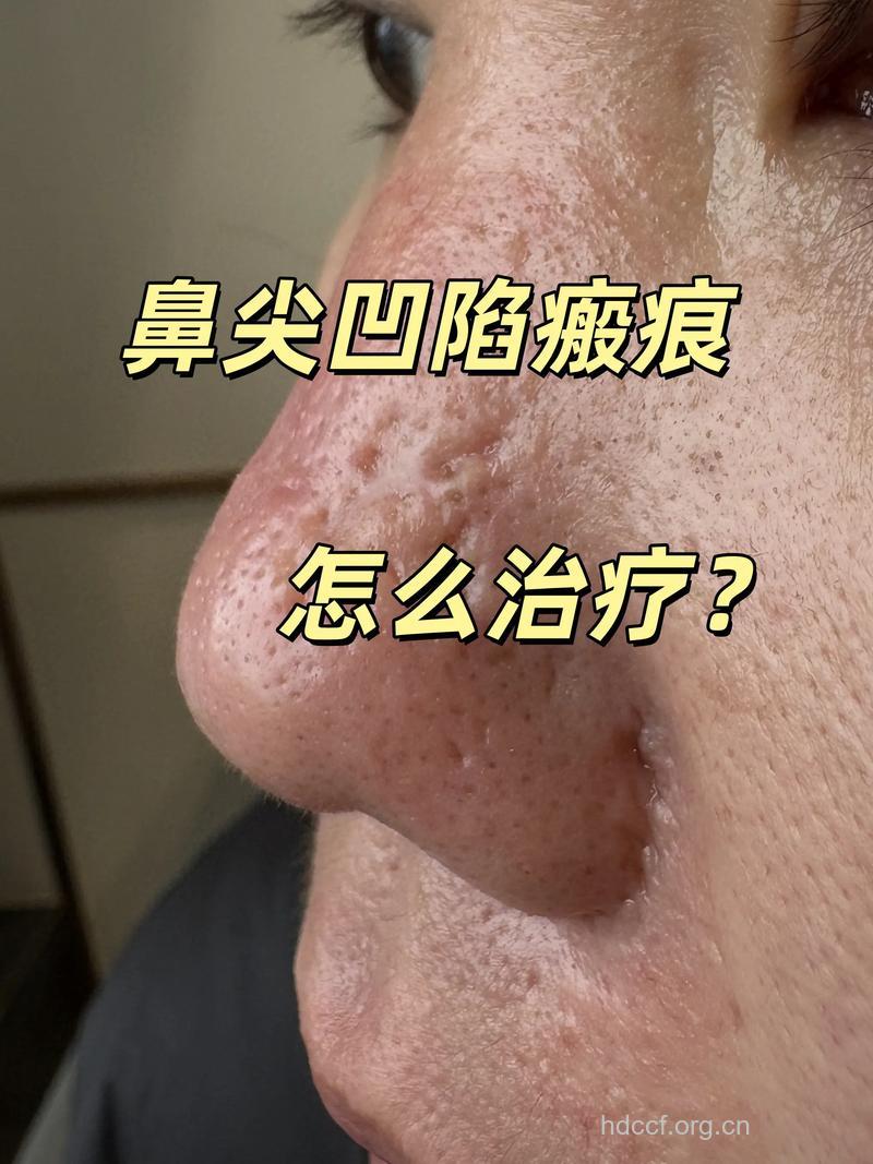 鼻部疤痕增生要怎么治疗