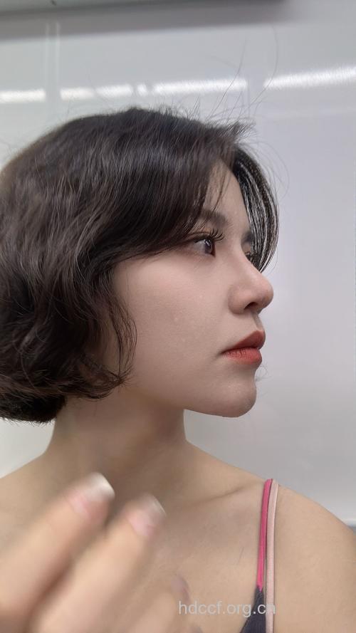 隆鼻最不想看到的术后效果是什么